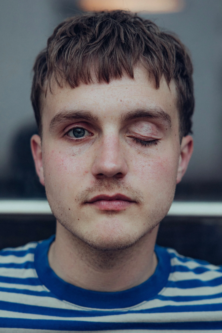 kjell brutscheidt eye condition